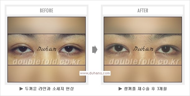 [두한성형외과 경쟁력 쌍꺼풀 재수술, 극한 눈재수술] - [두툼한 소세지 쌍꺼풀 라인 교정] 관련 이미지 13