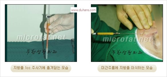 [두한성형외과 경쟁력 동안성형 리더] - ​[미간주름, 이마주름, 안검성형, 이마거상술, 눈썹거상술] 관련 이미지 5