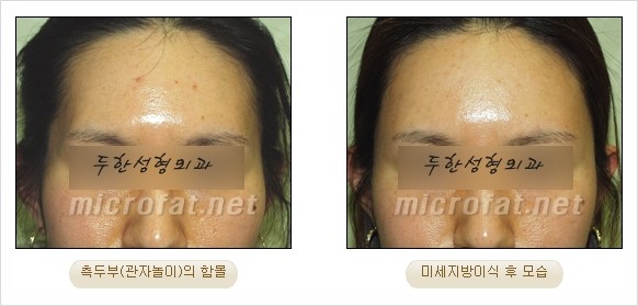 [두한성형외과 경쟁력 지방이식 리더] - [Col-fat(콜펫)지방이식, 3차원 입체지방이식, 2차원 평면지방이식] 관련 이미지 66