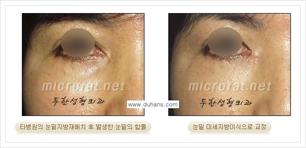 [두한성형외과 경쟁력 지방제거] - [눈밑(눈위)지방제거, 눈꺼풀(윗눈꺼풀)지방제거 안내 ②] 관련 이미지 8
