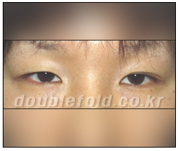 [Duhan Plastic Surgery Double Eyelid Revision Surgery] - [Ptosis Correction Surgery] image 8