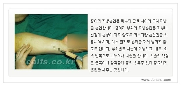 [두한성형외과 경쟁력 멀티종아리성형] - [정교한 미세흡입관 종아리 지방흡입술] 관련 이미지 6