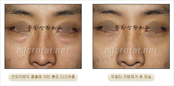 [두한성형외과 쌍커풀수술] - [눈성형 방법에 대한 자주하는 질문과 답변] 관련 이미지 184