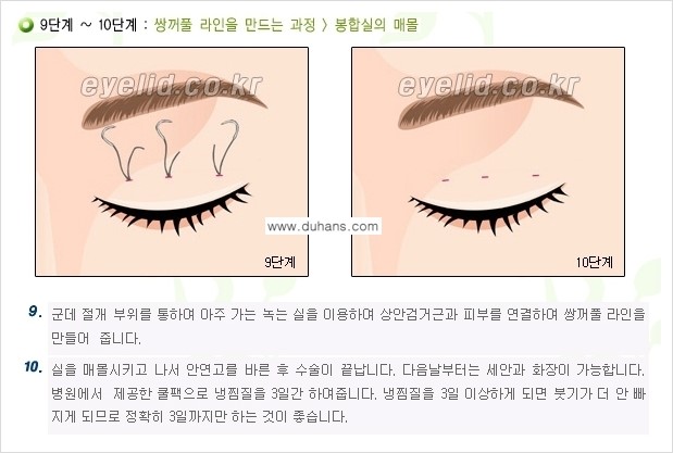 [두한성형외과 경쟁력 눈성형] - [퀵쌍꺼풀(부분절개법) 수술 안내] 관련 이미지 16