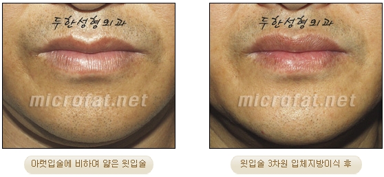 [Duhan Plastic Surgery Lip Surgery] - [Lip Correction Fat Grafting] image 22