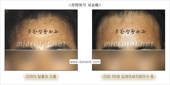 [두한성형외과 경쟁력 미세지방이식] - [두한성형외과 Col-fat(콜펫) 지방이식으로 교정이 가능한 부위 안내] 관련 이미지 2
