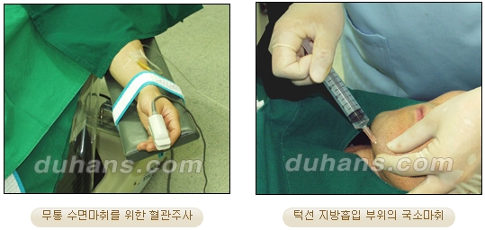 [두한성형외과 안전한 지방흡입] - [얼굴지방흡입] 관련 이미지 3