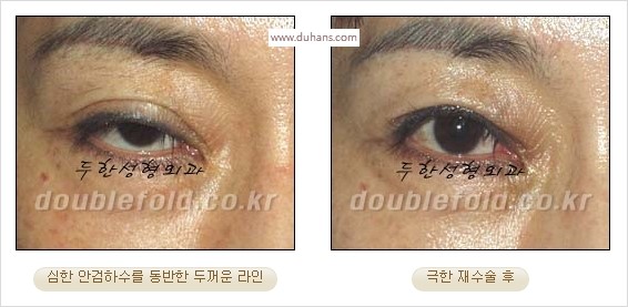 [두한성형외과 경쟁력 쌍꺼풀 재수술 스페셜] - [망가진 라인을 교정하는 극한 재수술] 관련 이미지 6