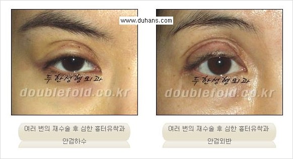 [두한성형외과 경쟁력 쌍꺼풀 재수술, 극한 재수술] - [재수술에서 극복해야 할 극한의 상황과 문제들 안내] 관련 이미지 11