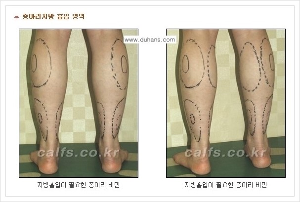 [두한성형외과 경쟁력 멀티종아리성형] - [두꺼운 종아리 정교한 미세흡입관 지방흡입술] 관련 이미지 2