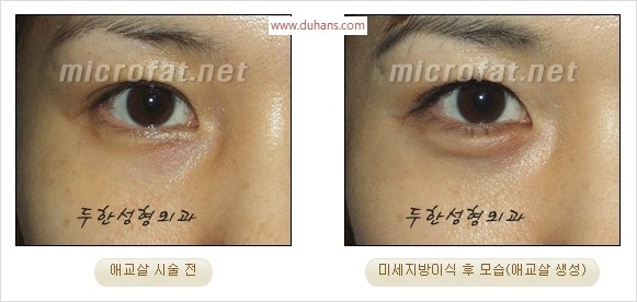​﻿[두한성형외과 경쟁력 지방이식] - [눈밑 애교살 시술을 위한 미세지방이식] 관련 이미지 6