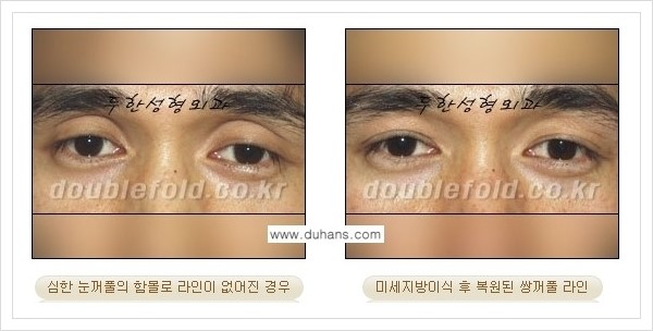 [두한성형외과 경쟁력 쌍꺼풀 재수술, 극한 재수술] - [미세지방이식으로 풀린 쌍꺼풀 교정] 관련 이미지 2
