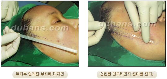 [Duhan Plastic Surgery Wrinkle Removal] - [Wrinkle Removal Treatment Methods] image 40