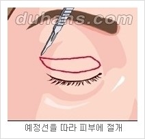 [두한성형외과 경쟁력 눈성형] - [젊은 눈매로의 복원 안검성형] 관련 이미지 3