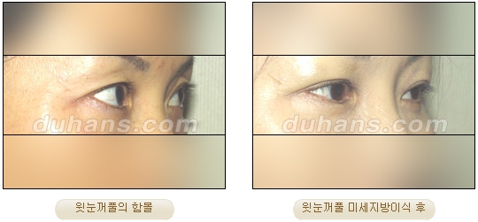 [Duhan Plastic Surgery Facial Autologous Fat Grafting] - [Fat Grafting Guide] image 7