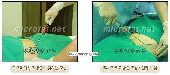 ​[두한성형외과 경쟁력 미세지방이식] - [타 병원에서 지방이식 후 발생한 굴곡현상 교정 방법 - 마이크로 지방이식] 관련 이미지 1