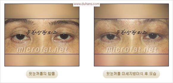 [두한성형외과 경쟁력 눈성형 리더] - [윗눈꺼풀 함몰( #꺼진눈꺼풀) 미세지방이식과 상안검성형]#꺼진눈성형 , #눈위함몰 관련 이미지 14