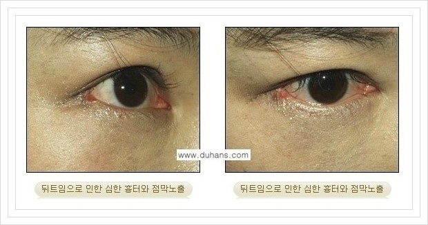 [두한성형외과 경쟁력 쌍꺼풀 재수술, 극한 눈재수술] - [뒤트임 부작용과 뒤트임 교정수술 방법 안내] 관련 이미지 12
