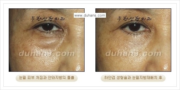 [두한성형외과 경쟁력 눈성형] - [젊은 눈매로의 복원 안검성형] 관련 이미지 22