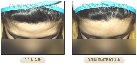[Duhan Plastic Surgery Facial Autologous Fat Grafting] - [Fat Grafting Guide] image 4