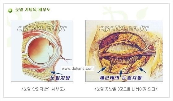[두한성형외과 경쟁력 지방제거] - [윗눈꺼풀 지방제거, 아랫 눈꺼풀 지방제거  안내 2.] 관련 이미지 1