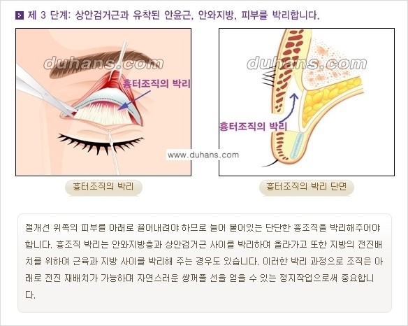 [두한성형외과 경쟁력 눈성형] - [쌍꺼풀 재수술 방법 - 완전절개법(Full incision method) 과정 안내] 관련 이미지 4