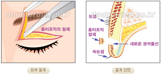[두한성형외과 쌍커풀재수술] - [심한 소세지눈, 두줄따기, 쌍꺼풀 흉터] 관련 이미지 9