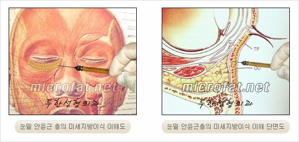 [두한성형외과 경쟁력 눈밑성형 리더] - [윗눈꺼풀 지방제거, 눈밑지방제거, 눈밑지방재배치, 눈밑지방이식 안내] 관련 이미지 19