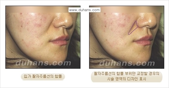 ⁠[두한성형외과 경쟁력 미세지방이식] - [귀족수술 - 입체미세지방이식 ①] 관련 이미지 5