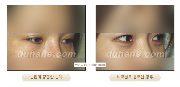 [두한성형외과 경쟁력 눈밑성형] - [밝고 젊게 보이는 눈밑 애교살 미세지방이식] 관련 이미지 4