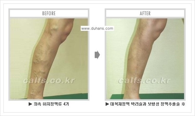 [두한성형외과 경쟁력 멀티종아리성형] - [하지정맥류 치료 안내] 관련 이미지 3