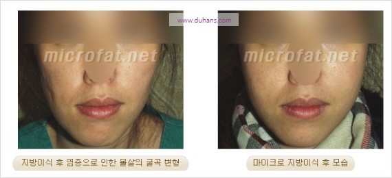 [두한성형외과 경쟁력 지방이식] - [두한 자가지방이식 클리닉 안내]​ 관련 이미지 81
