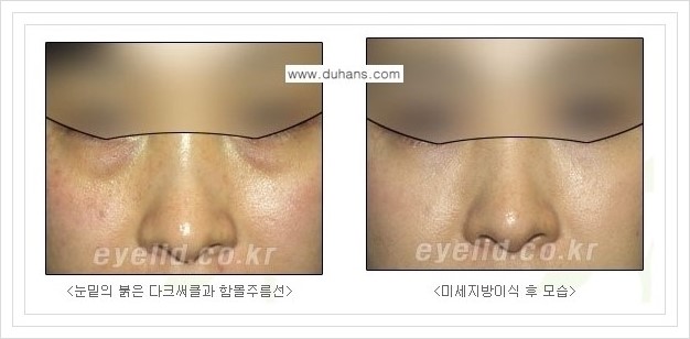 [두한성형외과 경쟁력 눈밑성형] - [눈밑 미세지방이식으로 다크써클 치료] 관련 이미지 11