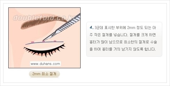 [두한성형외과 경쟁력 쌍꺼풀 재수술, 극한 재수술] - [쌍꺼풀 재수술의 과정 안내 1.] 관련 이미지 15