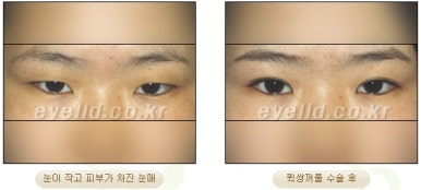 [Double Eyelid Surgery Duhan Plastic Surgery] - [Buried Method, Incision Method, Partial Incision Method] image 29