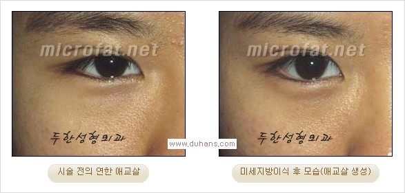 [두한성형외과 경쟁력 눈밑성형] - [타 병원 필러 애교살 시술 부작용을 미세지방이식으로 교정] 관련 이미지 26