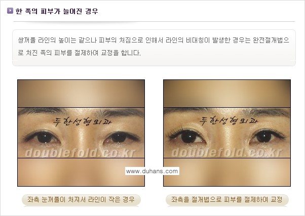 [두한성형외과 경쟁력 눈성형] - [비대칭(짝짝이) 쌍꺼풀 라인 교정 안내 ②] 관련 이미지 3