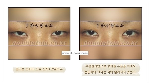 [두한성형외과 경쟁력 쌍꺼풀 재수술(극한 재수술)] - [안검하수(졸리운 눈매) 교정 안내 1.] 관련 이미지 3