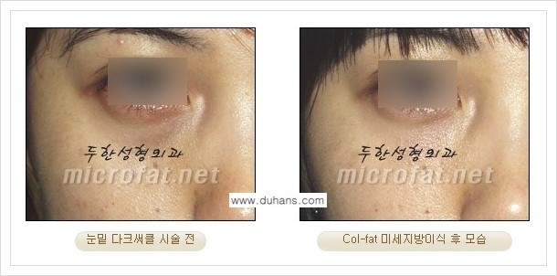 [두한성형외과 경쟁력 미세지방이식] - [상표등록 "Col-fat(콜펫) 지방이식"의 장점 안내] 관련 이미지 5