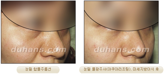 [두한성형외과 주름개선] - [주름교정 방법] 관련 이미지 23