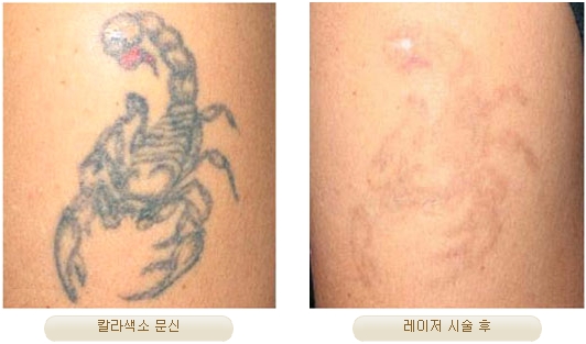 Duhan Plastic Surgery Laser Treatment - Mole Removal, Spot Removal, Melasma, Blemishes, Hyperpigmentation, Skin Tone Improvement, Elasticity Improvement, Skin Texture Improvement image 31