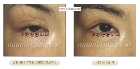 ​[두한성형외과 눈재수술] - [앞트임복원, 뒤트임복원, 쌍꺼풀복원] 관련 이미지 35