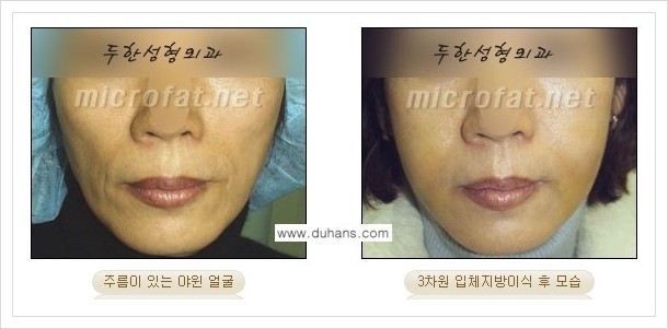 [두한성형외과 경쟁력 윤곽성형] - [볼, 볼살 지방이식] 관련 이미지 14
