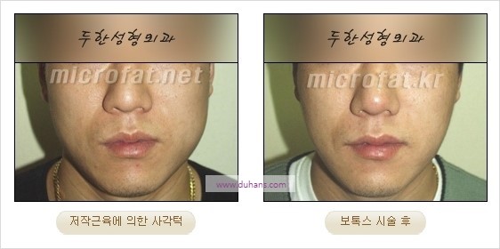 [두한성형외과 경쟁력 안면윤곽성형] - [보톡스(보툴리눔톡신)에 의한 사각턱 교정] 관련 이미지 4