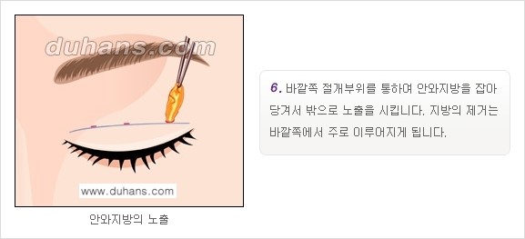 [두한성형외과 경쟁력 눈성형]- [최소 부기로 일상의로의 복귀가 가능한 아름다운 퀵쌍꺼풀(부분절개법) 수술] 관련 이미지 6