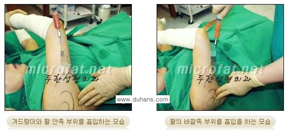 [두한성형외과 경쟁력 바디성형] - [아랫배, 윗배, 옆구리살, 허리살, 팔뚝살 지방흡입] 관련 이미지 8