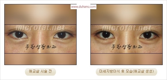 ​﻿[두한성형외과 경쟁력 지방이식] - [눈밑 애교살 시술을 위한 미세지방이식] 관련 이미지 46