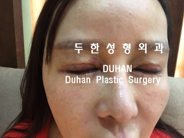 #쌍꺼풀재수술 지방전진 #재배치 를 통해 라인 자연스럽게 낮추기, #눈재수술 #인라인 관련 이미지 4