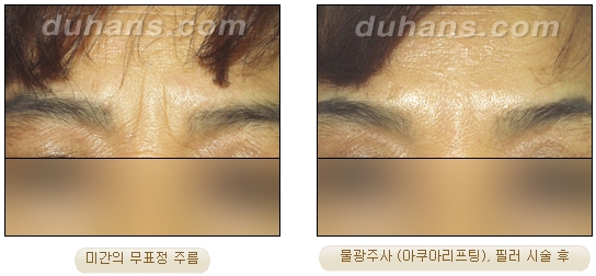 Duhan Plastic Surgery Wrinkle Improvement - Wrinkle Fillers, Juvederm image 12