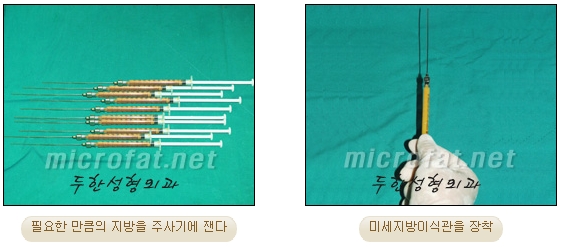 [두한성형외과 미세지방이식] - [무턱교정 안내] 관련 이미지 11